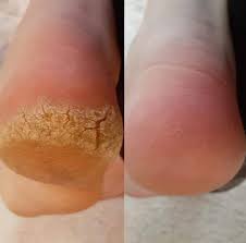 Şarjlı Topuk ve Nasır Temizleyici